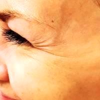 Botox Around Eyes Can Smooth Out The Wrinkles
