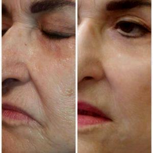 Botox As Preventative Treatment (2)