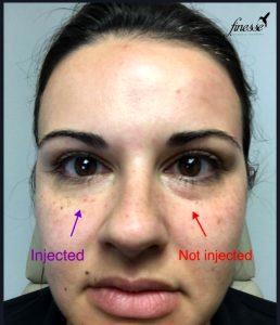 Botox Bags Under Your Eyes Before And After