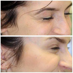 Botox Before After Photos Crows Feet (1)