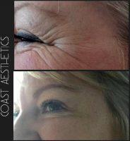 Botox Before After Photos Crows Feet