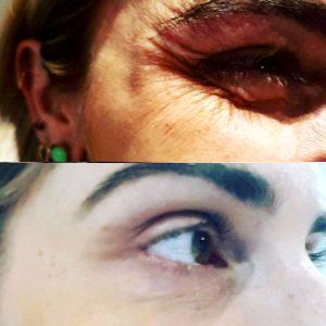 Botox Before After Photos Crows Feet (2)