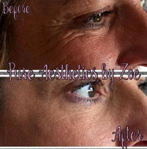 Botox Before After Photos Crows Feet (3)