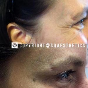 Botox Before After Photos Crows Feet (4)