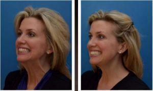 Botox Before And After By Dr. Henry G. Wells Jr, MD, Plastic Surgeon In Lexington, Kentucky (1)