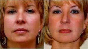 Botox Before And After By Dr. Henry G. Wells Jr, MD, Plastic Surgeon In Lexington, Kentucky (2)