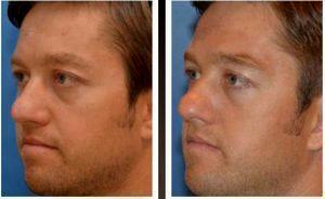 Botox Before And After By Dr. Henry G. Wells Jr, MD, Plastic Surgeon In Lexington, Kentucky (3)