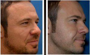 Botox Before And After By Dr. Henry G. Wells Jr, MD, Plastic Surgeon In Lexington, Kentucky (4)