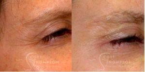 Botox Before And After Photos By Dr. Scott K. Thompson,Salt Lake City