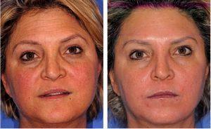Botox Before And After Photos Dr. S. Kent Brown, Plastic Surgeon, In Scottsdale, Arizona