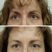 Botox Brow Lift Injections Before & After