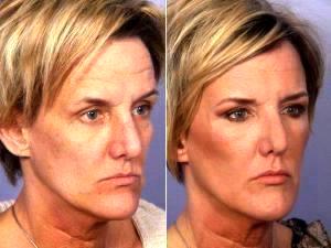 Botox By Dr. Grant Stevens, MD, Los Angeles Plastic Surgeon