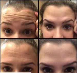 Botox By Dr. Ronald Ackerman, Obstetrician-Gynecologist In West Palm Beach