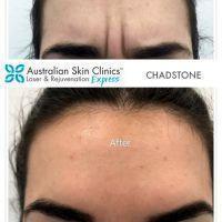 Botox Can Be Diluted To Different Concentrations