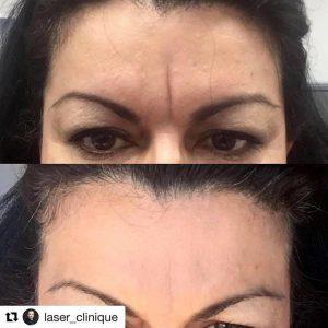 Botox Cosmetic To Soften The Appearance Of Her Frown Lines By Dr. P. Alexander Ataii, M.D., Dermatologist In San Diego, California