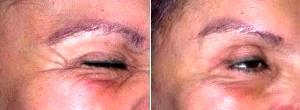 Botox Crows Feet Dysport By Doctor Philip Young, MD, Bellevue Facial Plastic Surgeon