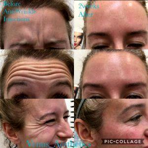 Botox Crows Feet Frown Lines In Late 20s Before And After 2 Weeks