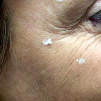 Botox Crows Feet Lasts Up To 4 To 5 Months