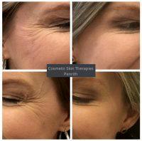 Botox Crows Feet Swelling Before After