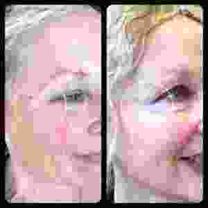 Botox Crows Feet Under Eyes Before And After