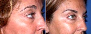 Botox Crows Feet With Dr. Shahram Salemy, MD, FACS, Seattle Plastic Surgeon