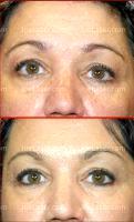 Botox Eyebrow Lift Treatment Before And After
