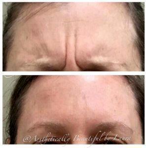 Botox For 11 Wrinkles Before And After (2)