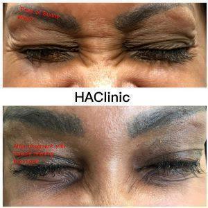 Botox For Bunny Lines At HAclinic