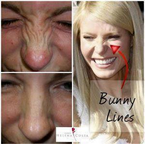 Botox For Bunny Lines Photos (4)