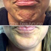 Botox For Chin Area
