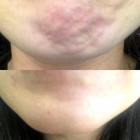 Botox For Chin Before And After (2)