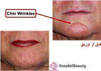 Botox For Chin Wrinkles