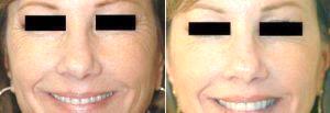 Botox For Crows Feet By Doctor Harold J. Kaplan, MD, Los Angeles Facial Plastic Surgeon