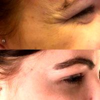 Botox For Crow's Feet Procedure Picture
