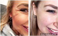Botox For Crows Feet When Smiling Pictures