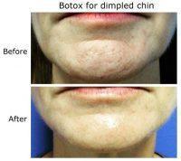 Botox For Dimpled Chin