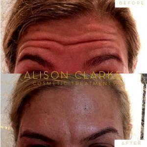 Botox For Forehead In Late 20s Before And After (2)