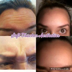 Botox For Forehead In Late 20s Before And After (3)