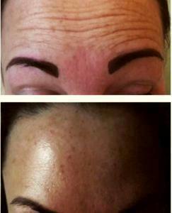 Botox For Forehead In Late 20s Before And After (4)