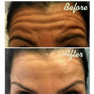 Botox For Forehead In Late 20s Before And After (5)