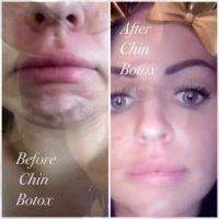 Botox For Golf Ball Chin Before And After