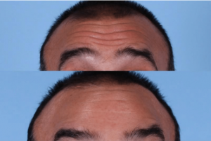 Botox For Men At Avalon Laser, Skin Care Clinic In San Diego, California
