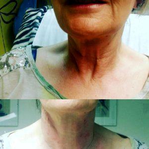 Botox For Neck Weakness