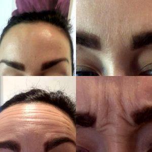 Botox For Nose And Forehead Wrinkles Before And After