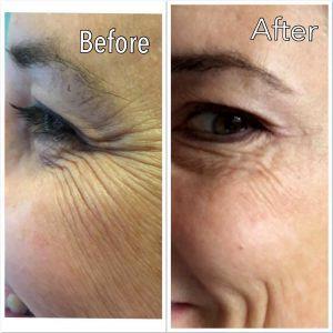 Botox For Under Eyes Lines