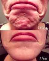 Botox For Wrinkled Chin