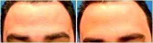 Botox Forehead Lines By Dr. Henry G. Wells Jr, MD, Plastic Surgeon In Lexington, Kentucky (3)