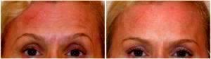 Botox Forehead Lines By Dr. Henry G. Wells Jr, MD, Plastic Surgeon In Lexington, Kentucky (4)