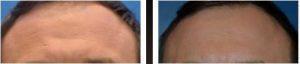 Botox Forehead Lines By Dr. Henry G. Wells Jr, MD, Plastic Surgeon In Lexington, Kentucky (5)