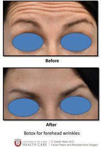 Botox Forehead Wrinkles By P. Daniel Ward, MD, Plastic Surgeon In Cottonwood Heights, Utah